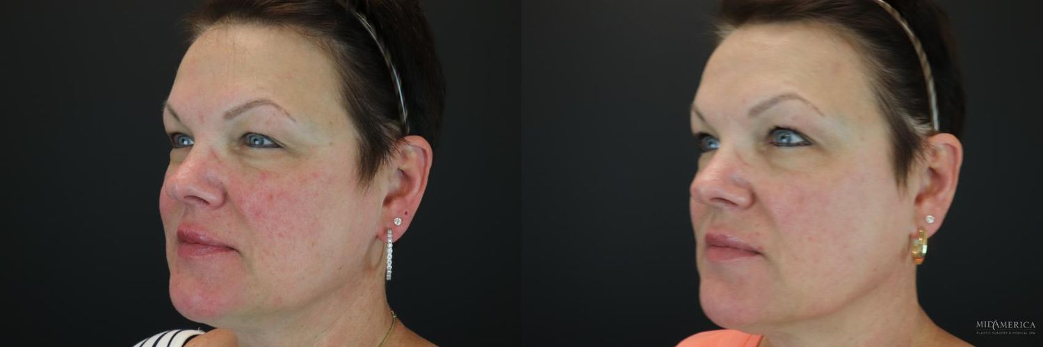 Laser Services Before & After