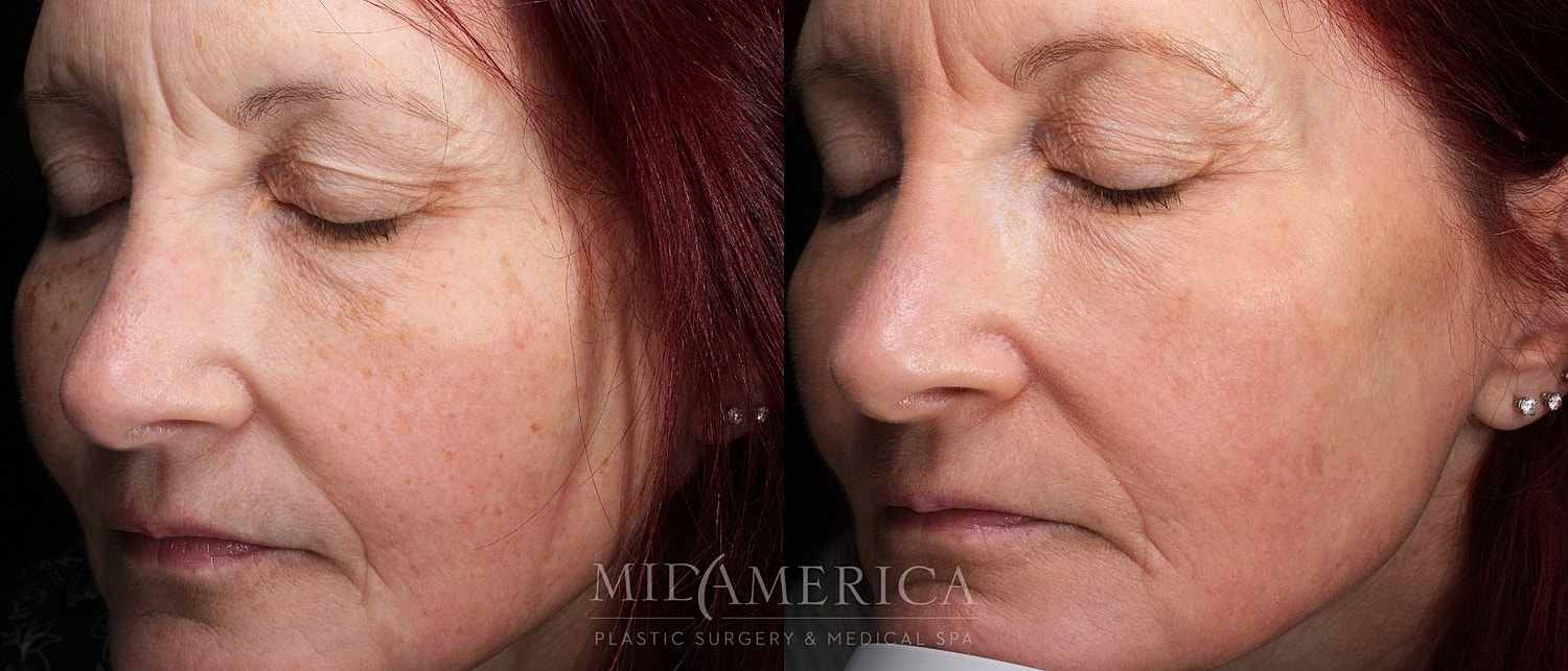 Skin Resurfacing Before & After