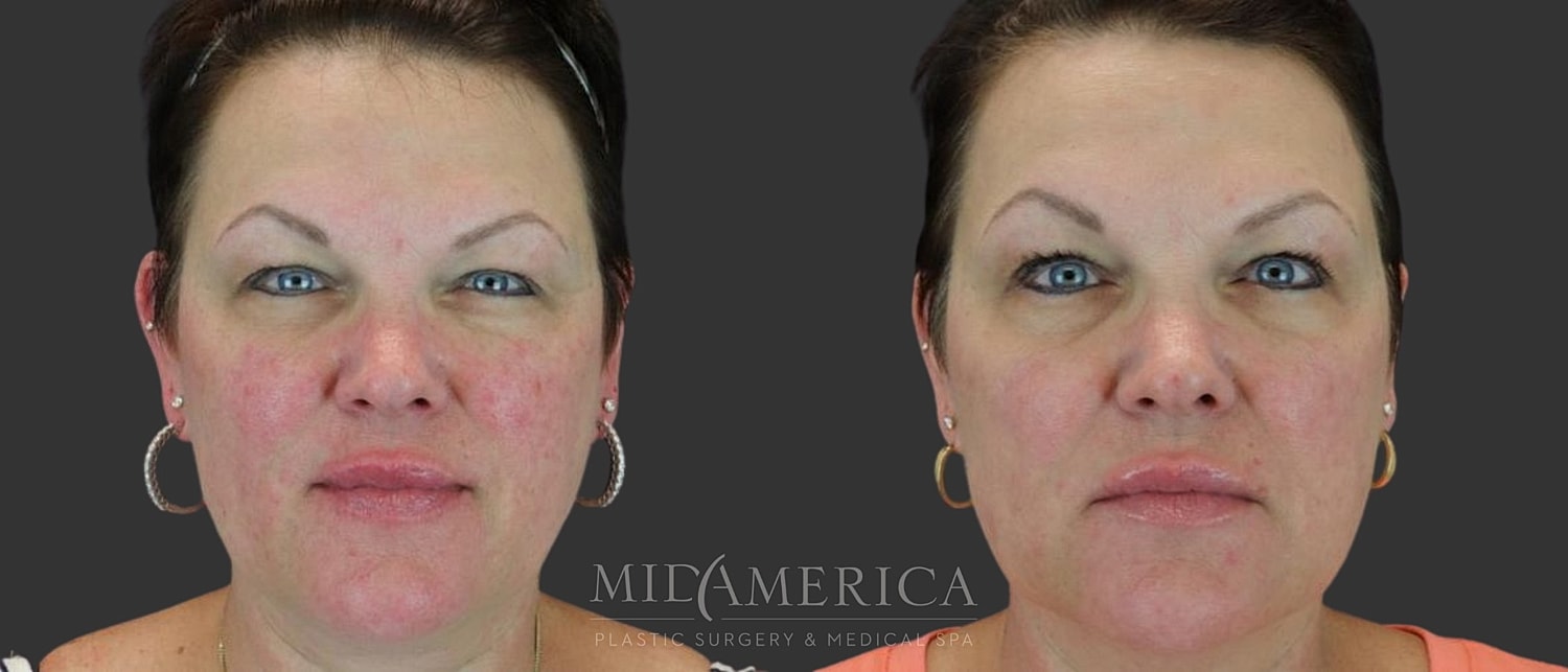 Laser Services Before & After