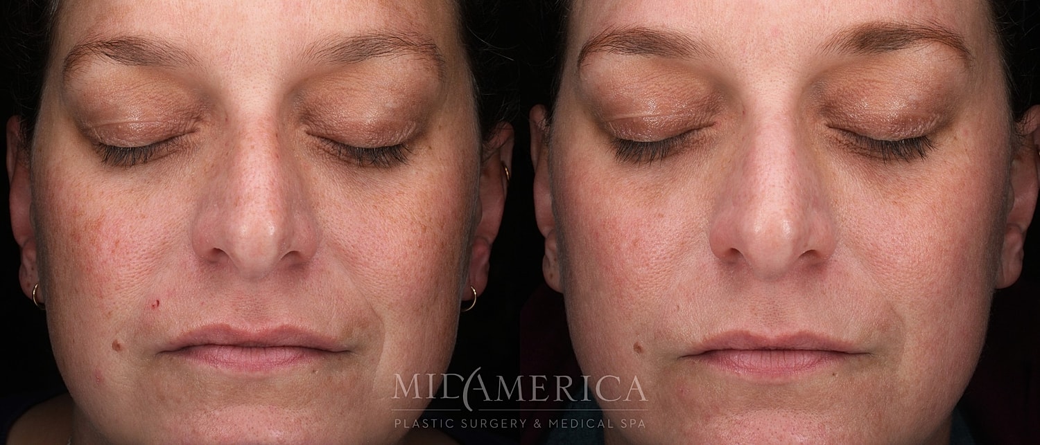 Skin Resurfacing Before & After