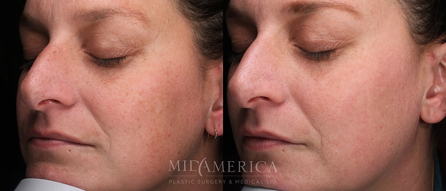 Skin Resurfacing Before & After