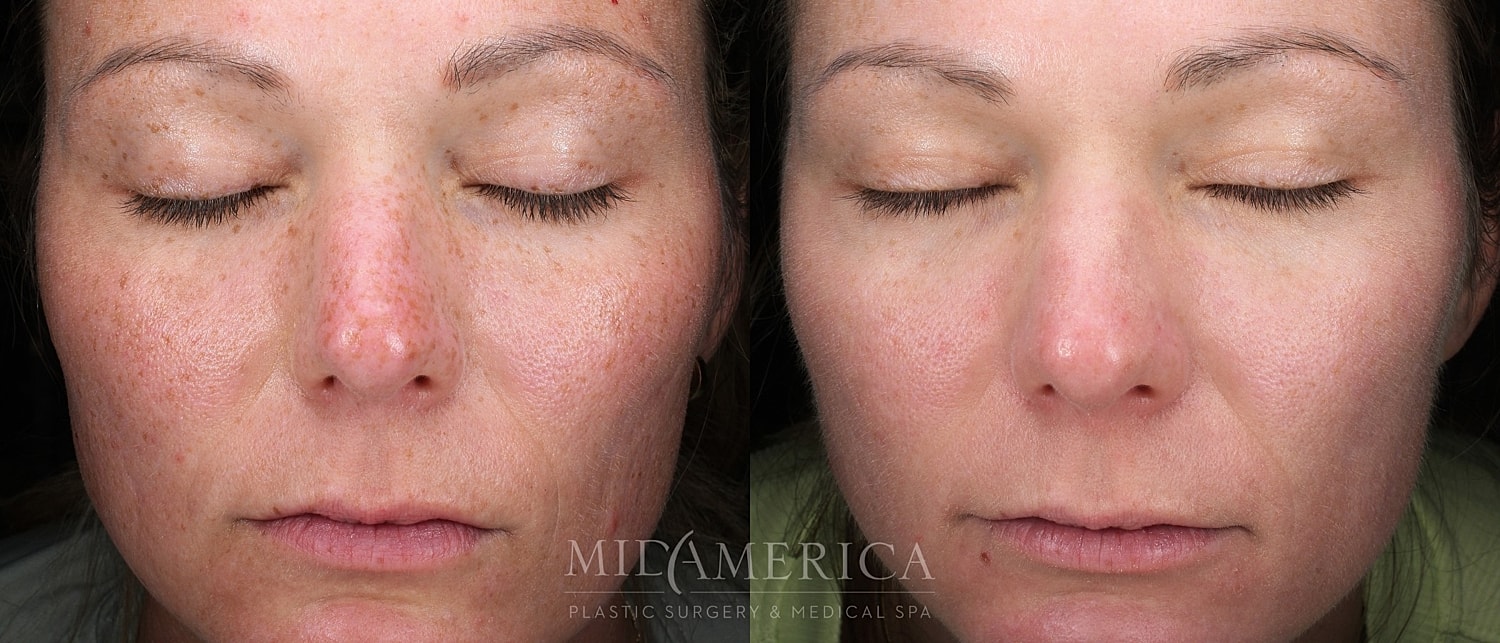 Skin Resurfacing Before & After