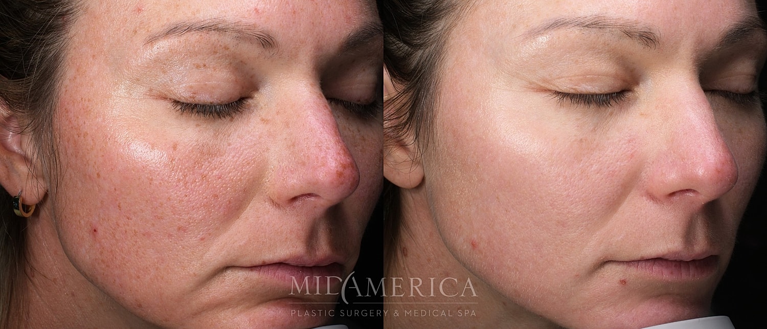 Skin Resurfacing Before & After
