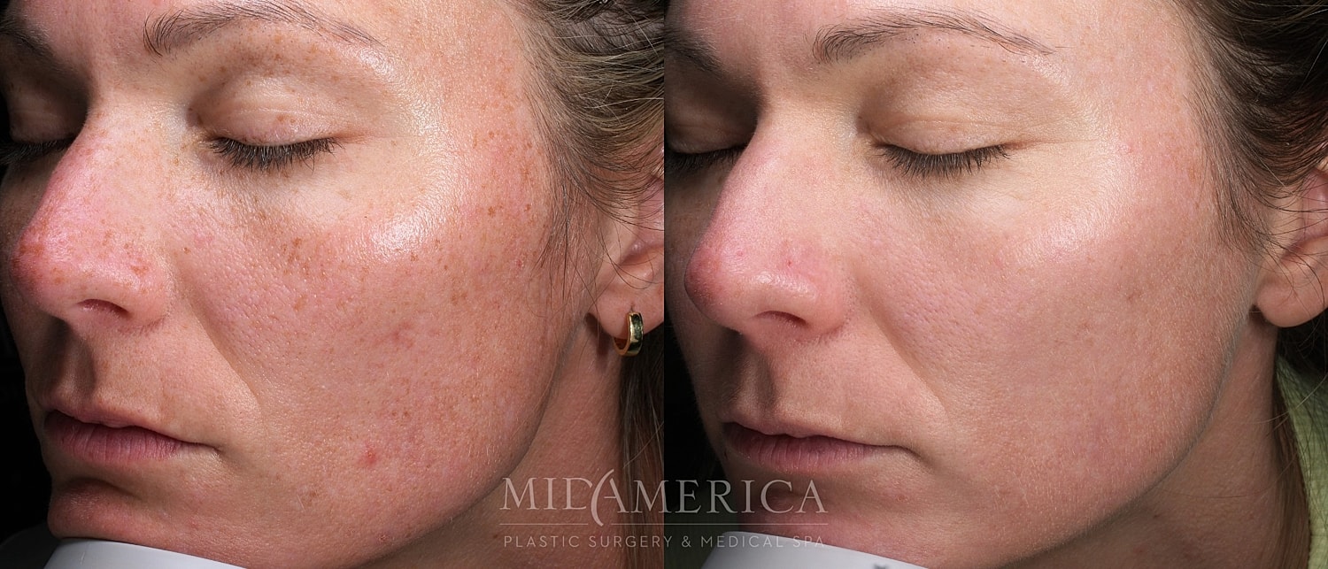 Skin Resurfacing Before & After
