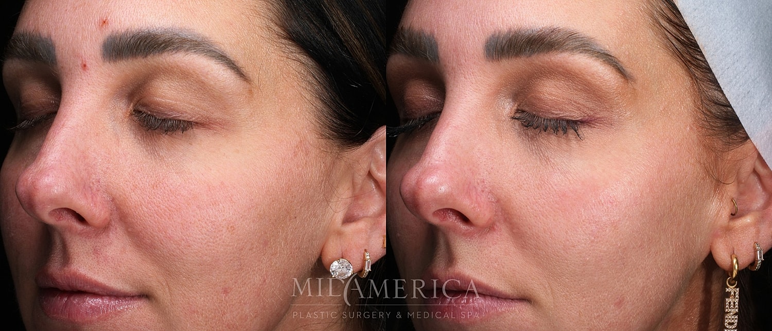 Skin Resurfacing Before & After