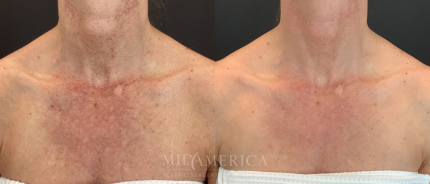 Skin Resurfacing Before & After