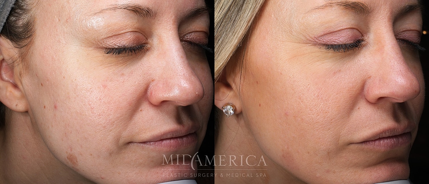 Before and after skin treatment comparison image.