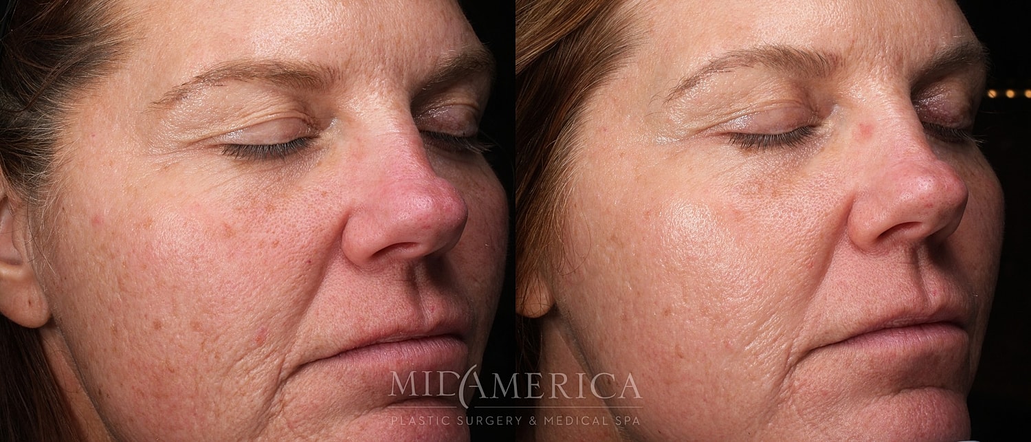 Before and after facial treatment comparison.