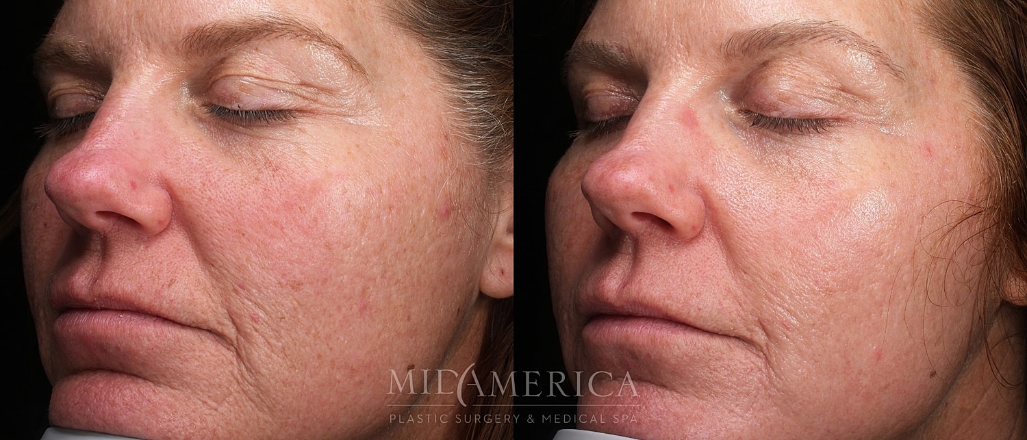 Before and after facial treatment comparison.