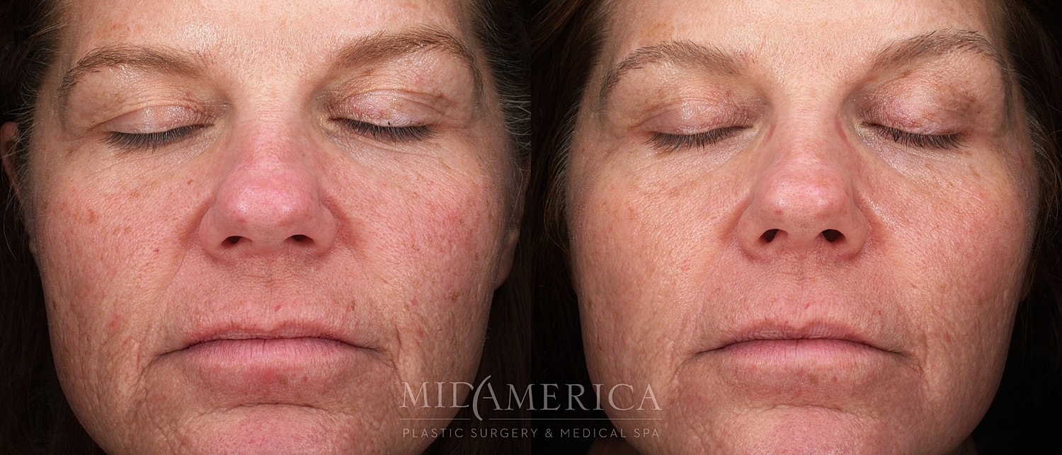 Before and after facial skin treatment comparison.