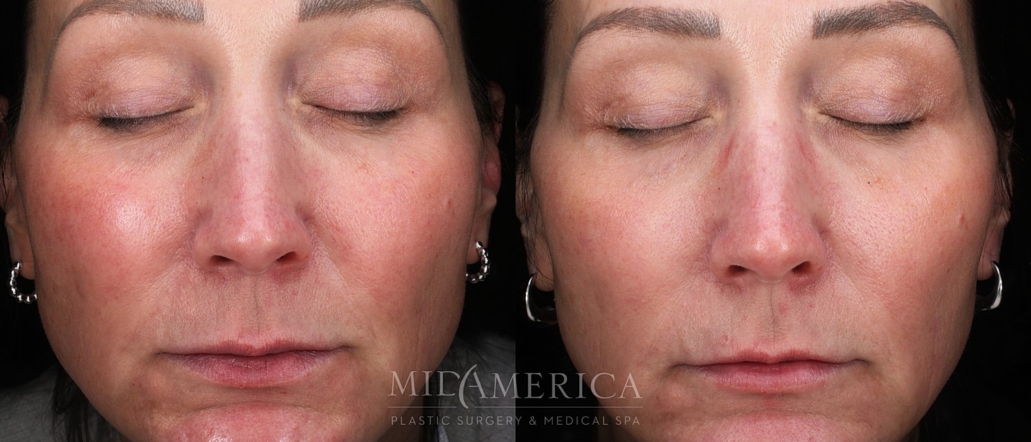 Before and after facial treatment comparison.