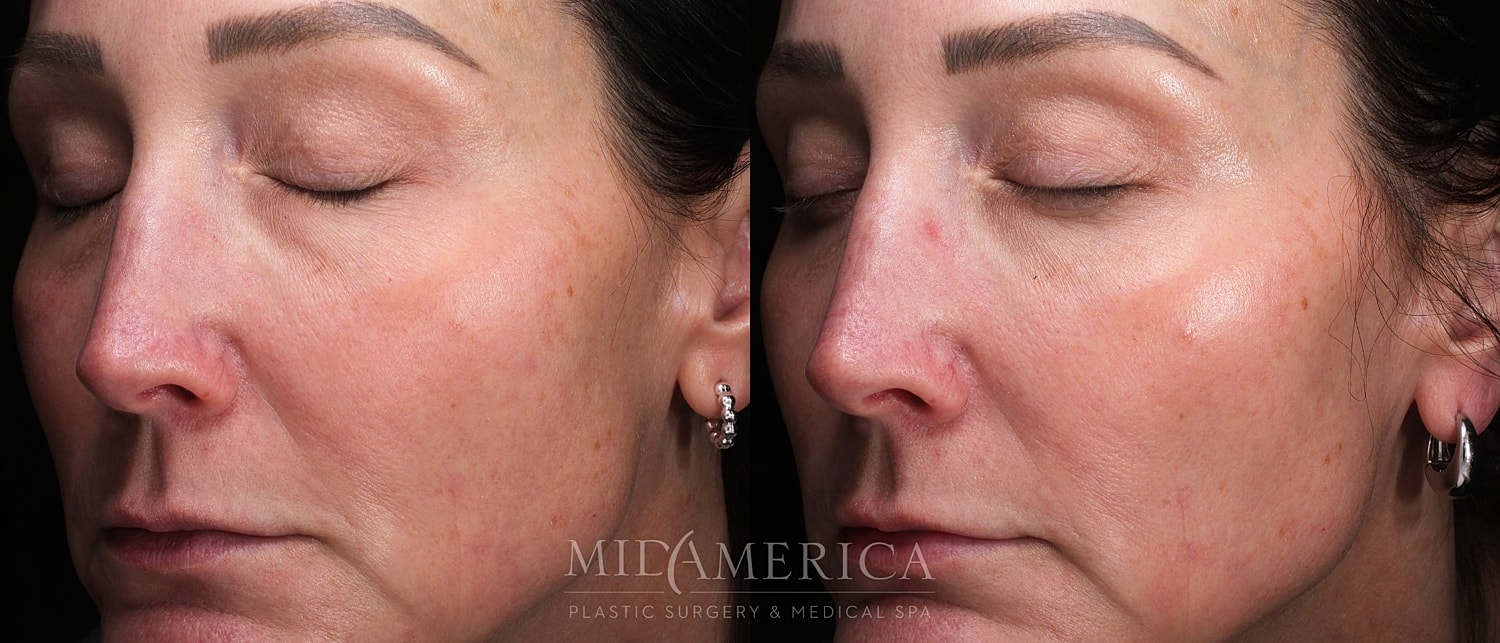Before and after facial treatment comparison.