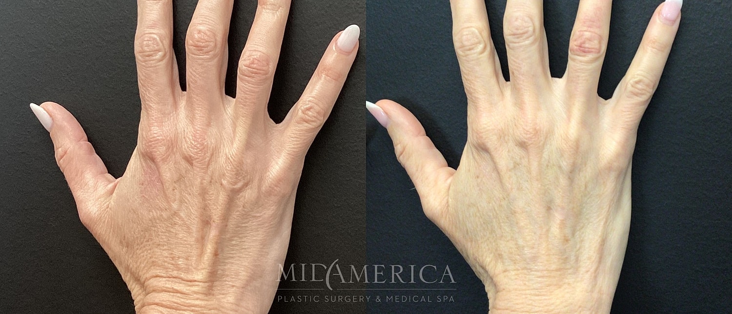 Comparison of hand appearance before and after treatment.