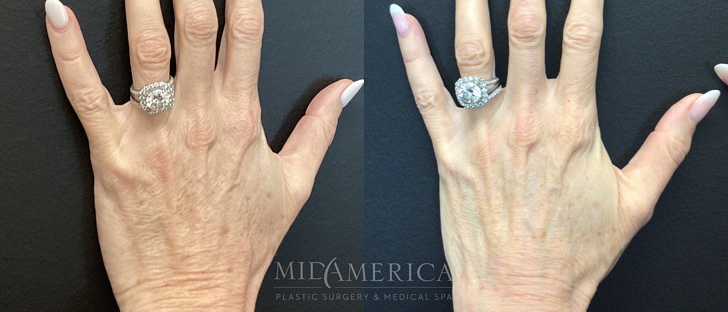 Before and after hand with ring.