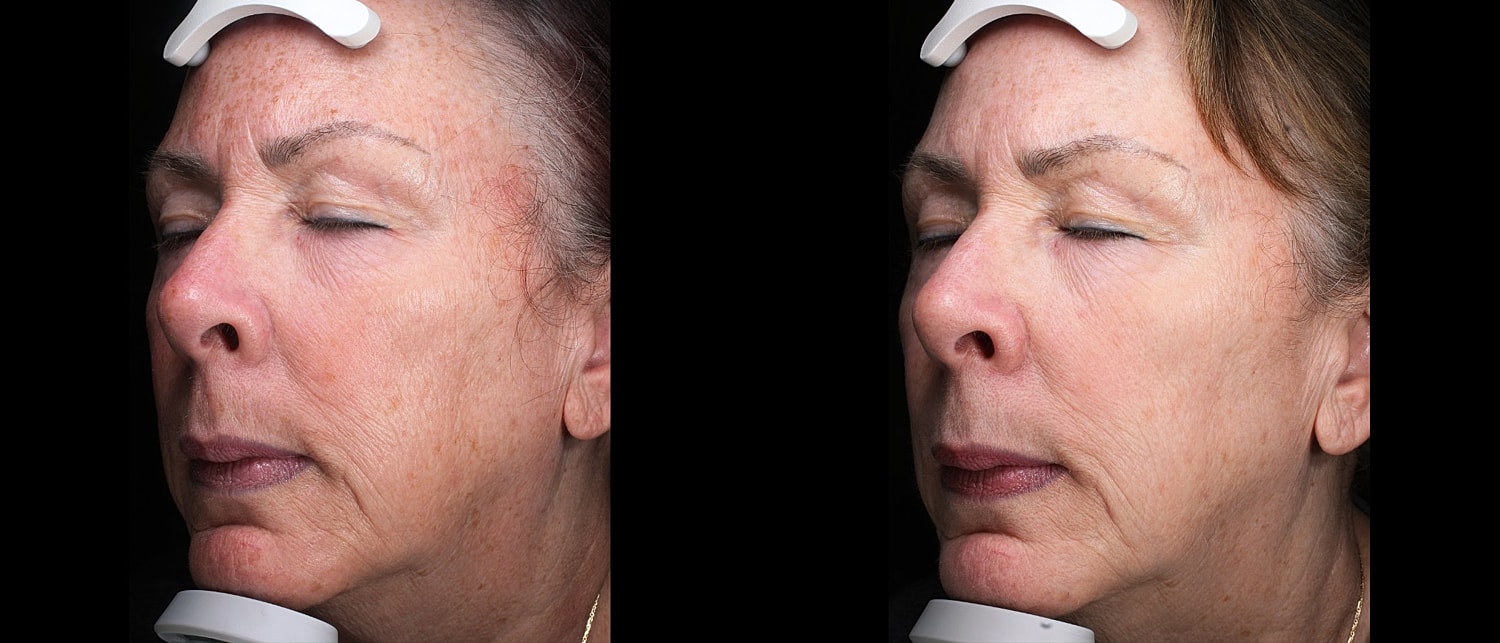 Before and after facial treatment comparison image.