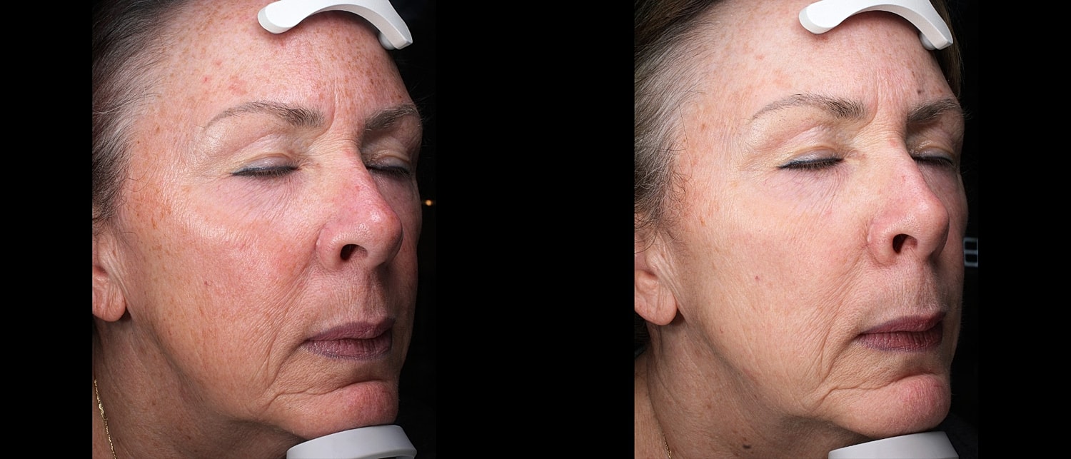 Before and after facial treatment comparison.