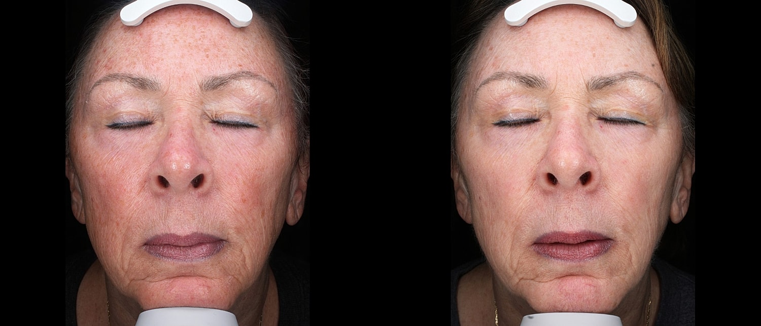 Before and after facial treatment comparison image.