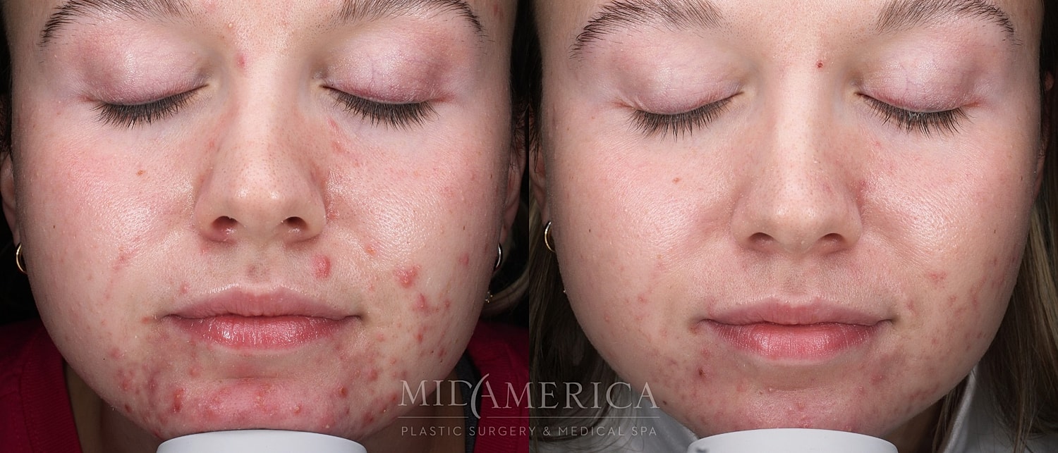 Before and after skin treatment comparison.