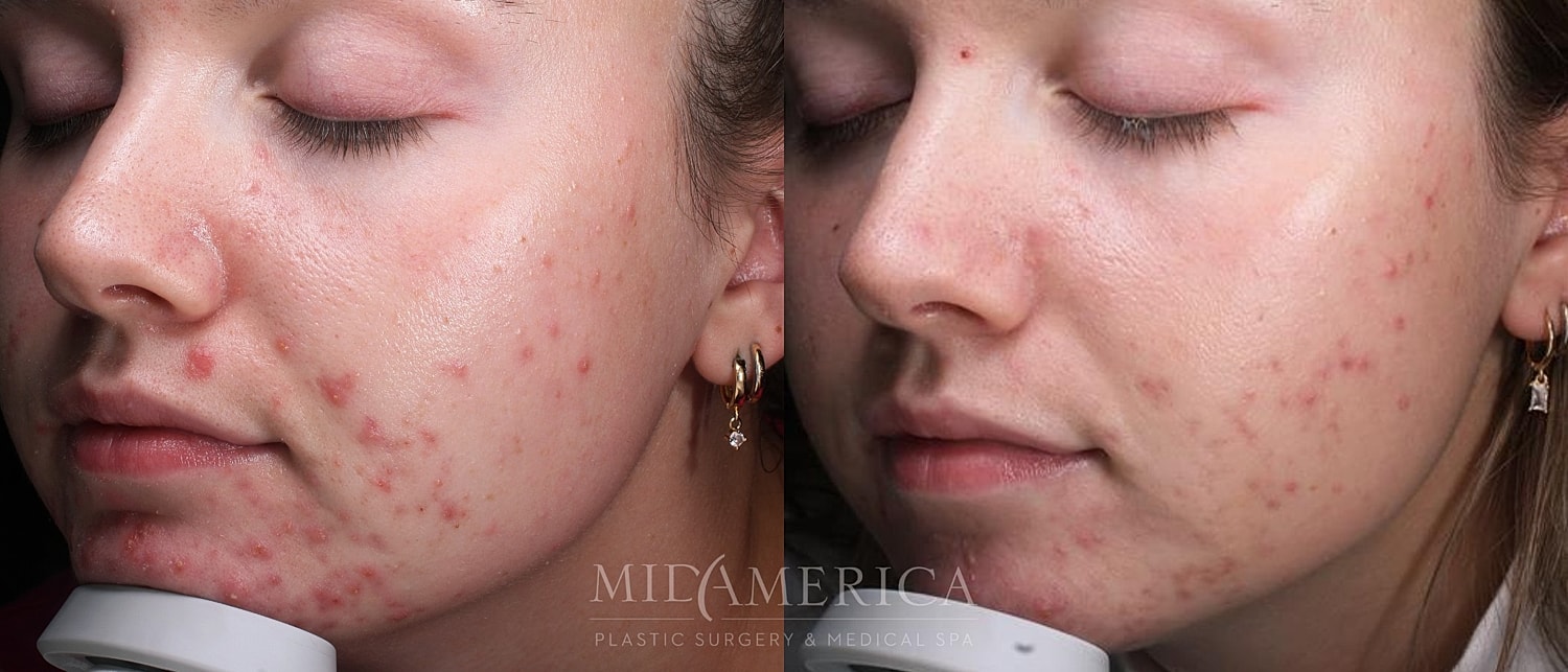 Before and after acne treatment comparison.