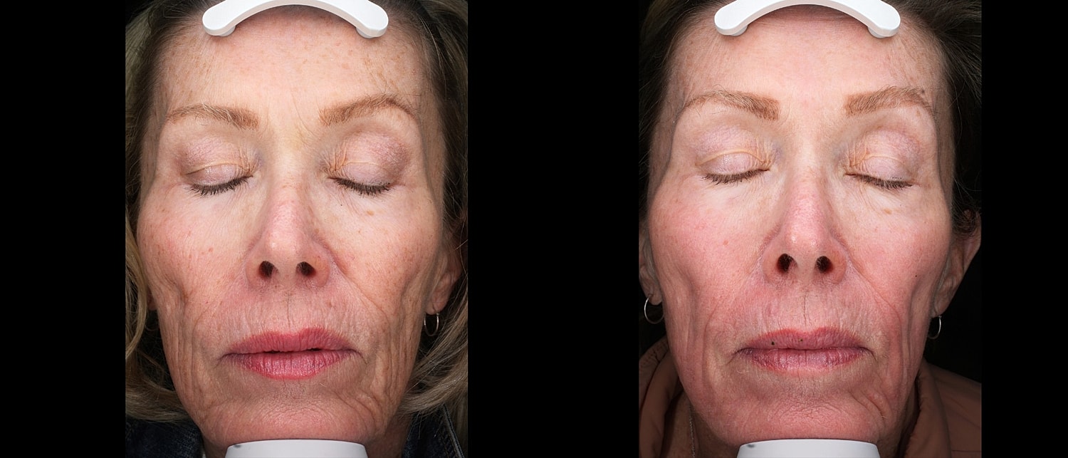 Before and after facial treatment comparison photo.