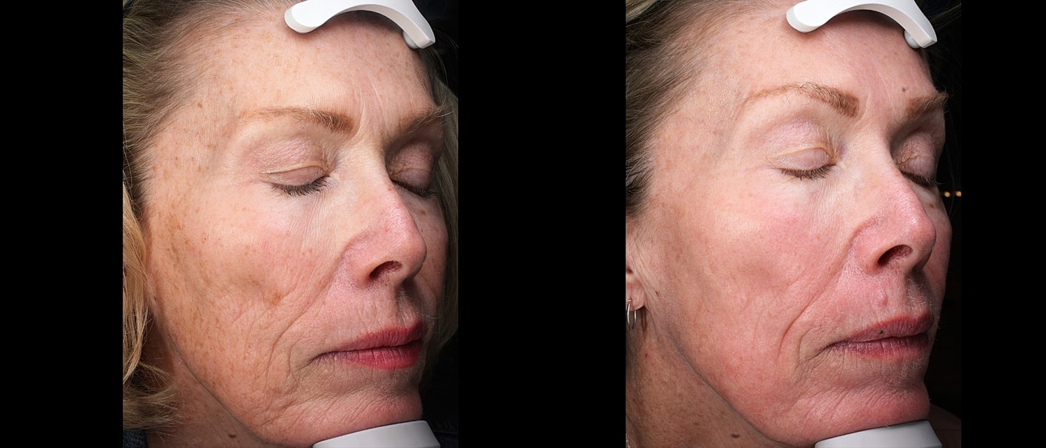 Skin Resurfacing Before & After