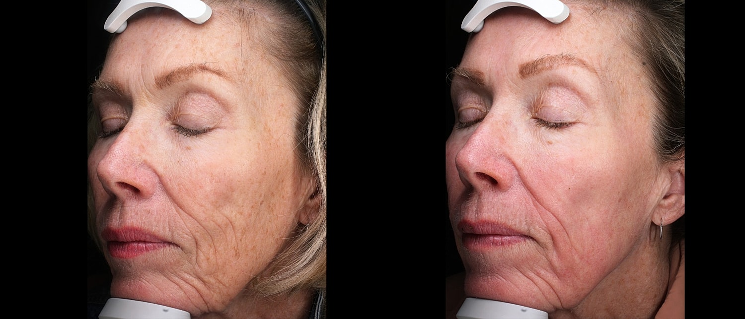 Before and after skin treatment comparison.