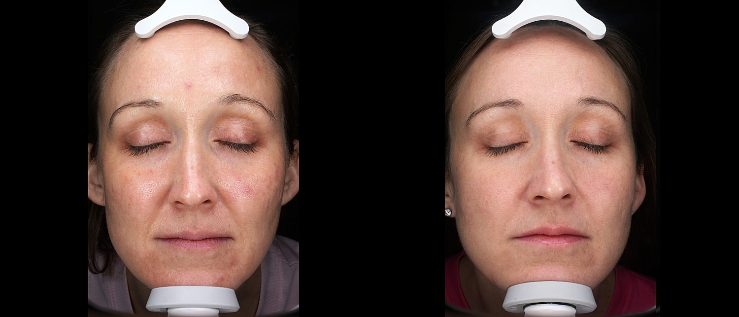 Before and after skin treatment comparison.