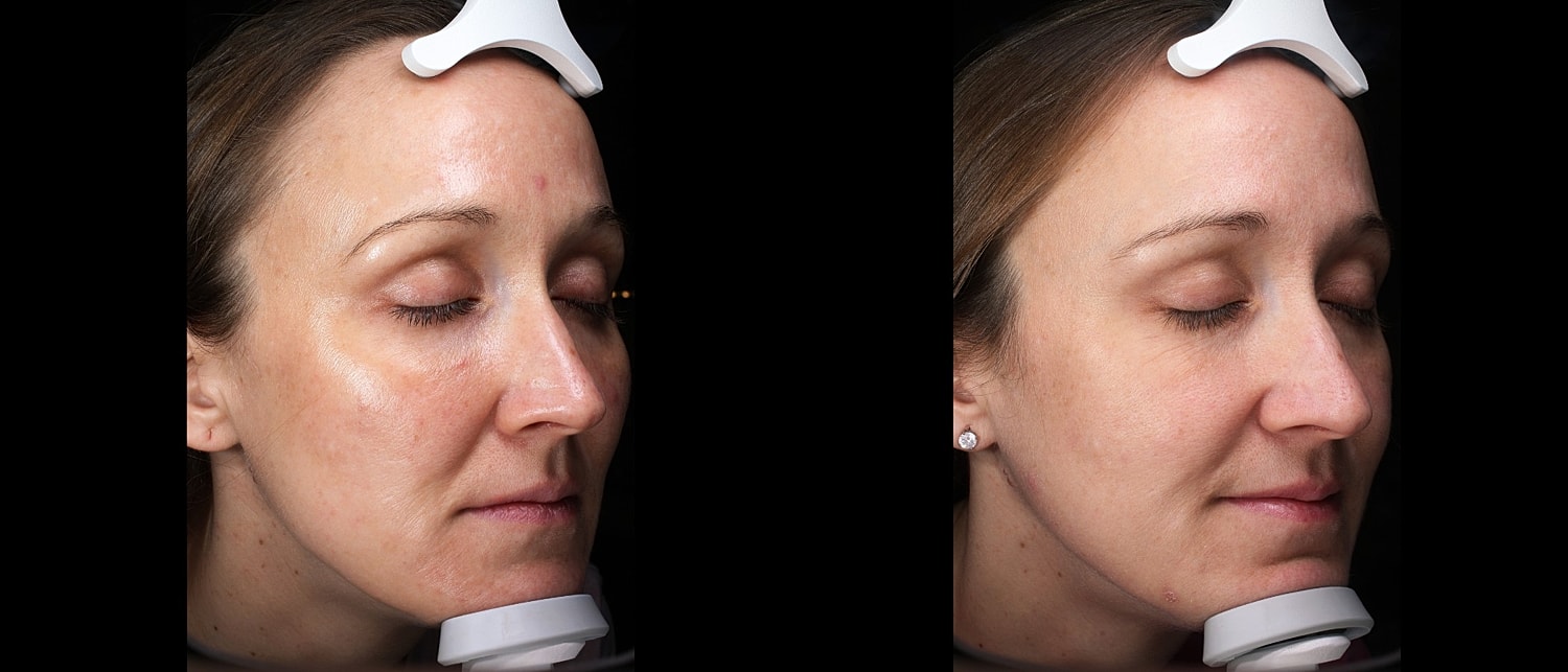 Before and after facial treatment comparison.