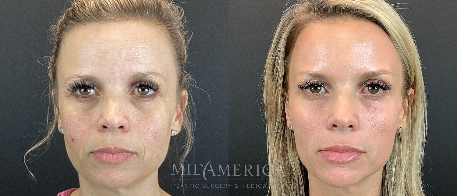 Skin Resurfacing Before & After
