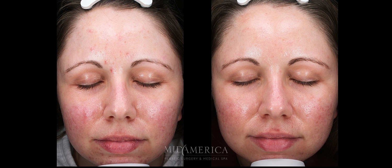 Before and after skincare treatment comparison.