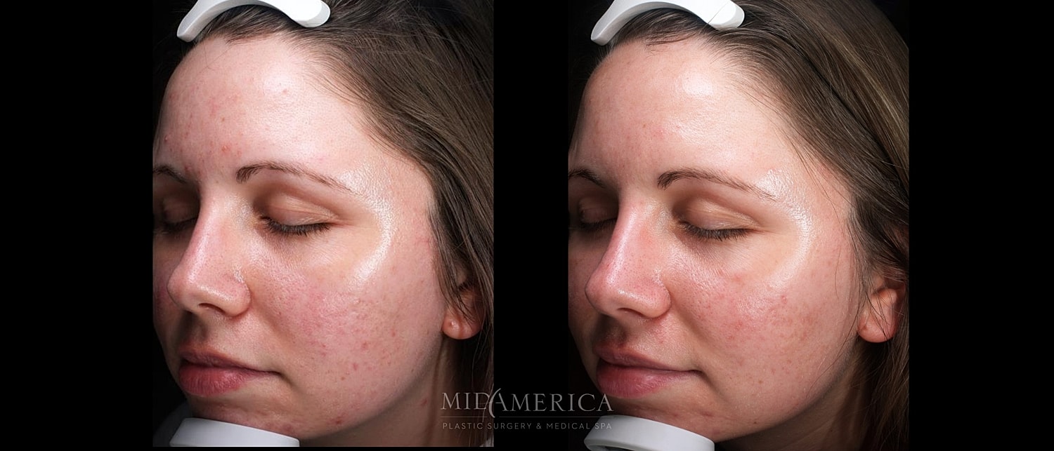 Before and after facial skin treatment comparison.