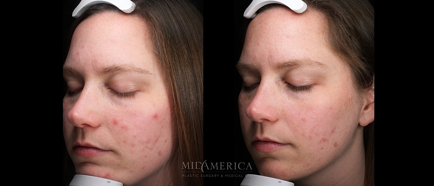 Skin Resurfacing Before & After