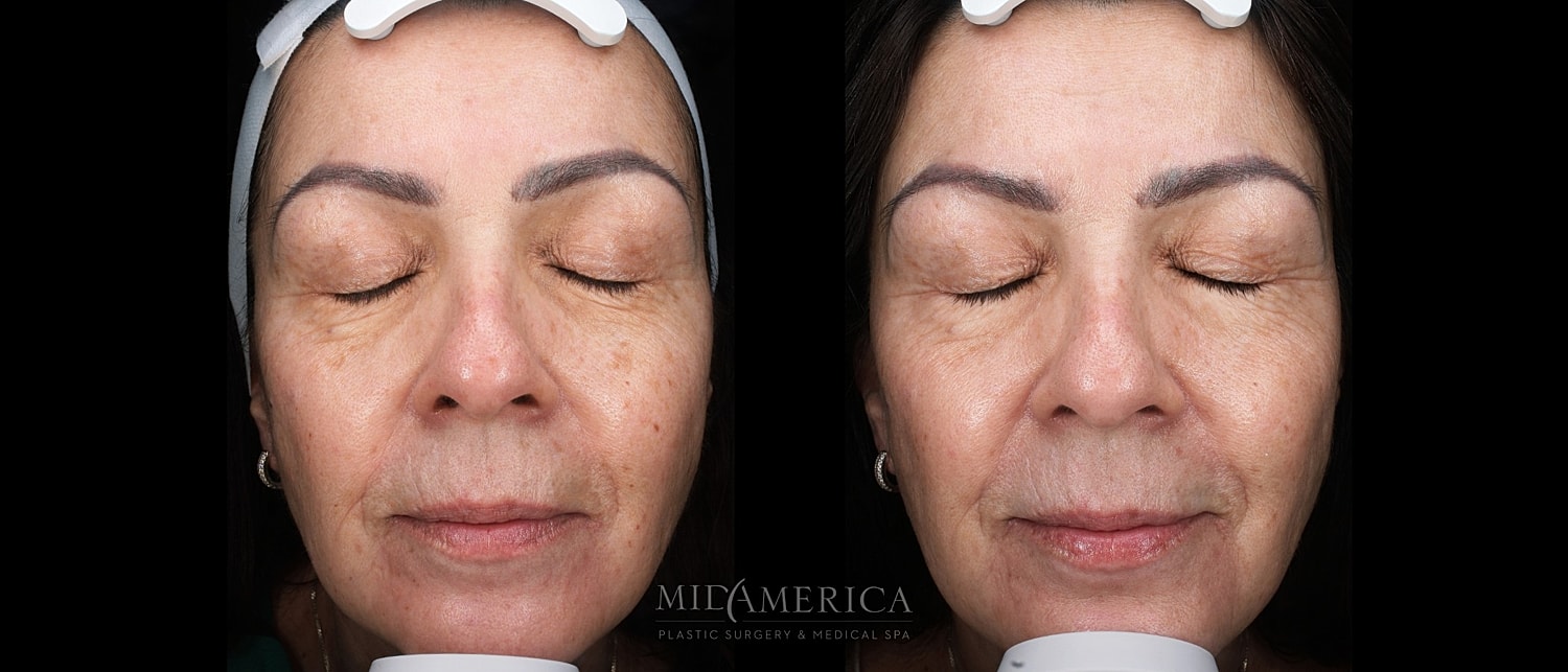Skin Resurfacing Before & After