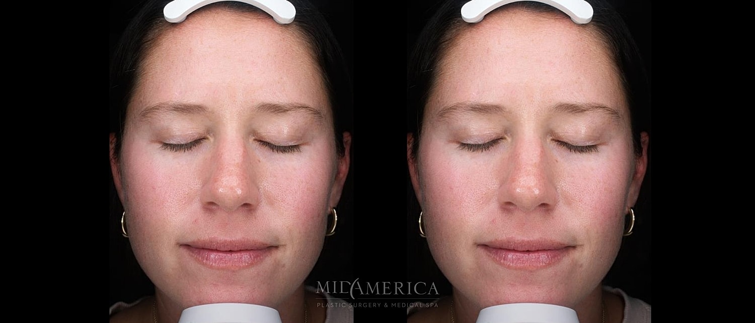 Skin Resurfacing Before & After