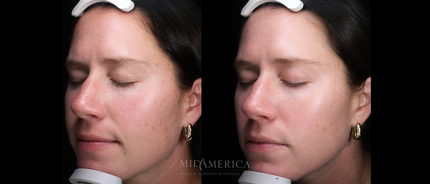 Skin Resurfacing Before & After