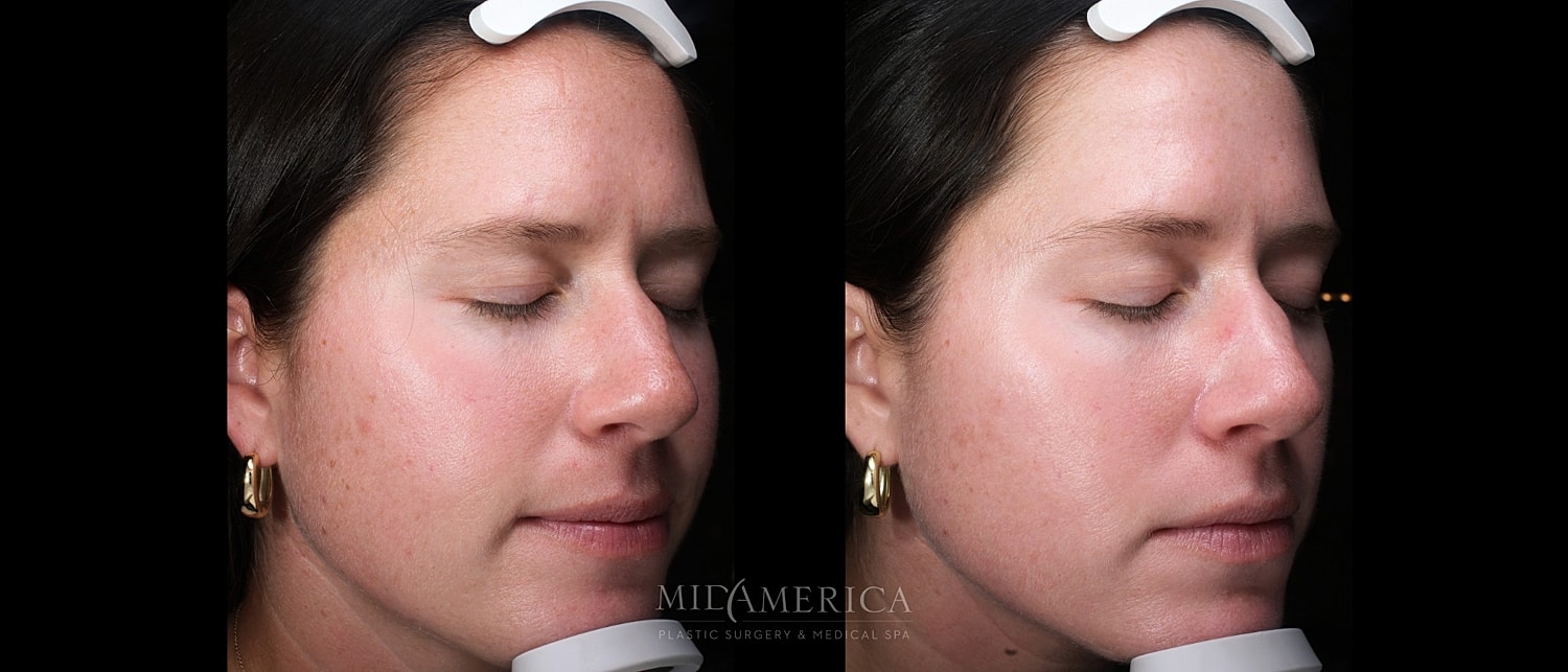 Skin Resurfacing Before & After