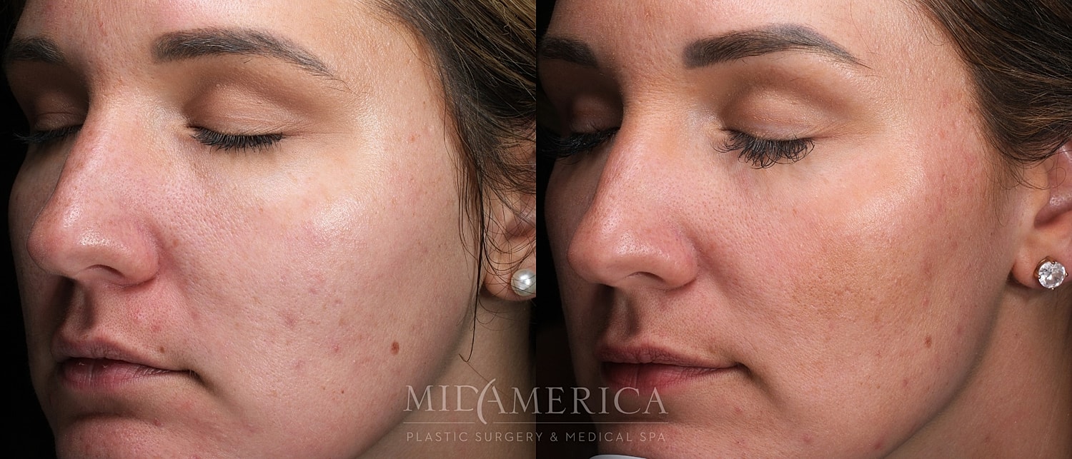 Skin Resurfacing Before & After