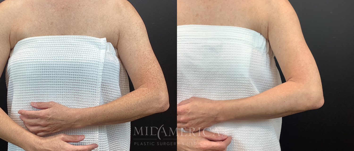 Laser Services Before & After