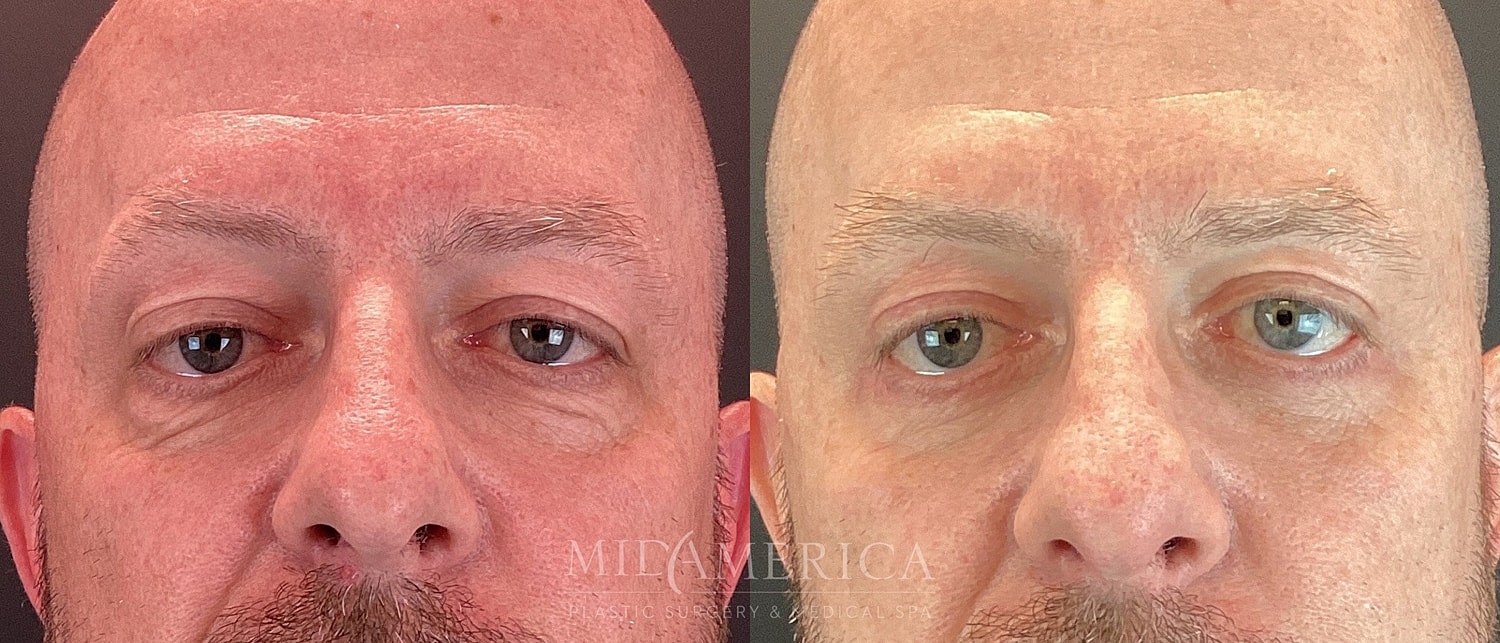Lower Eyelid Surgery Before & After