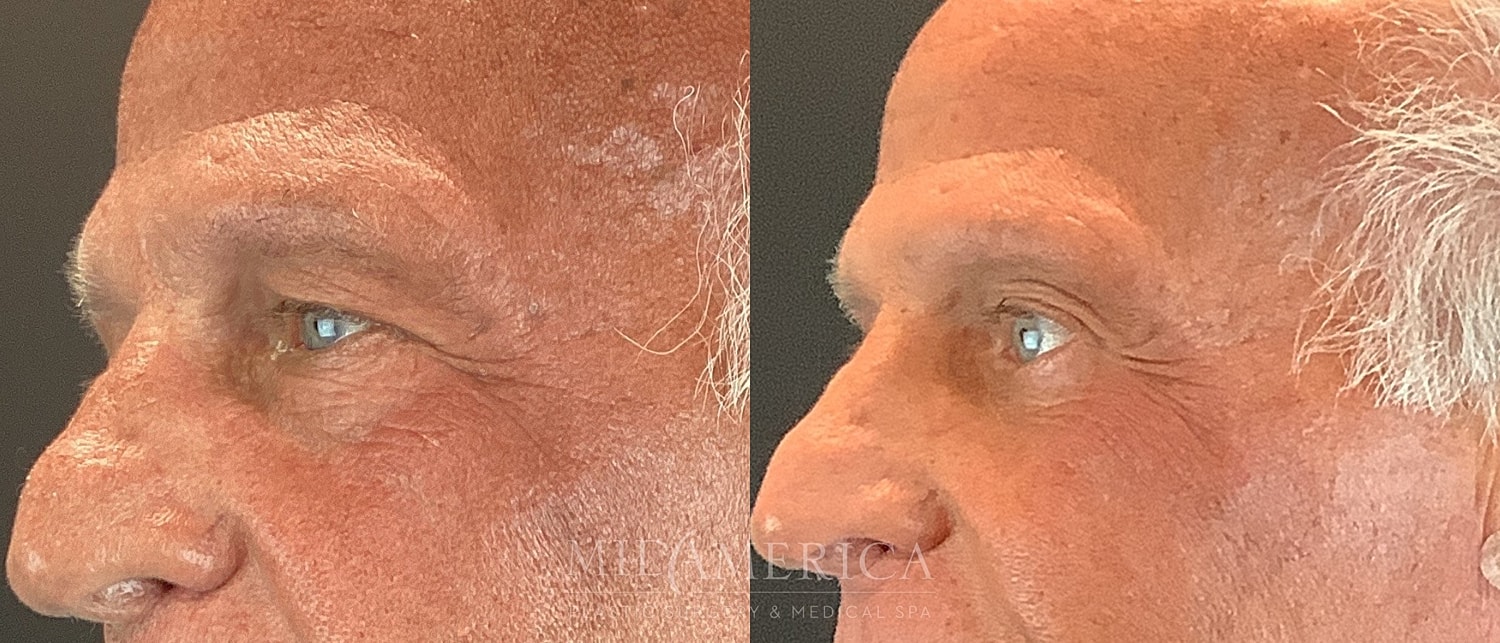 Lower Eyelid Surgery Before & After