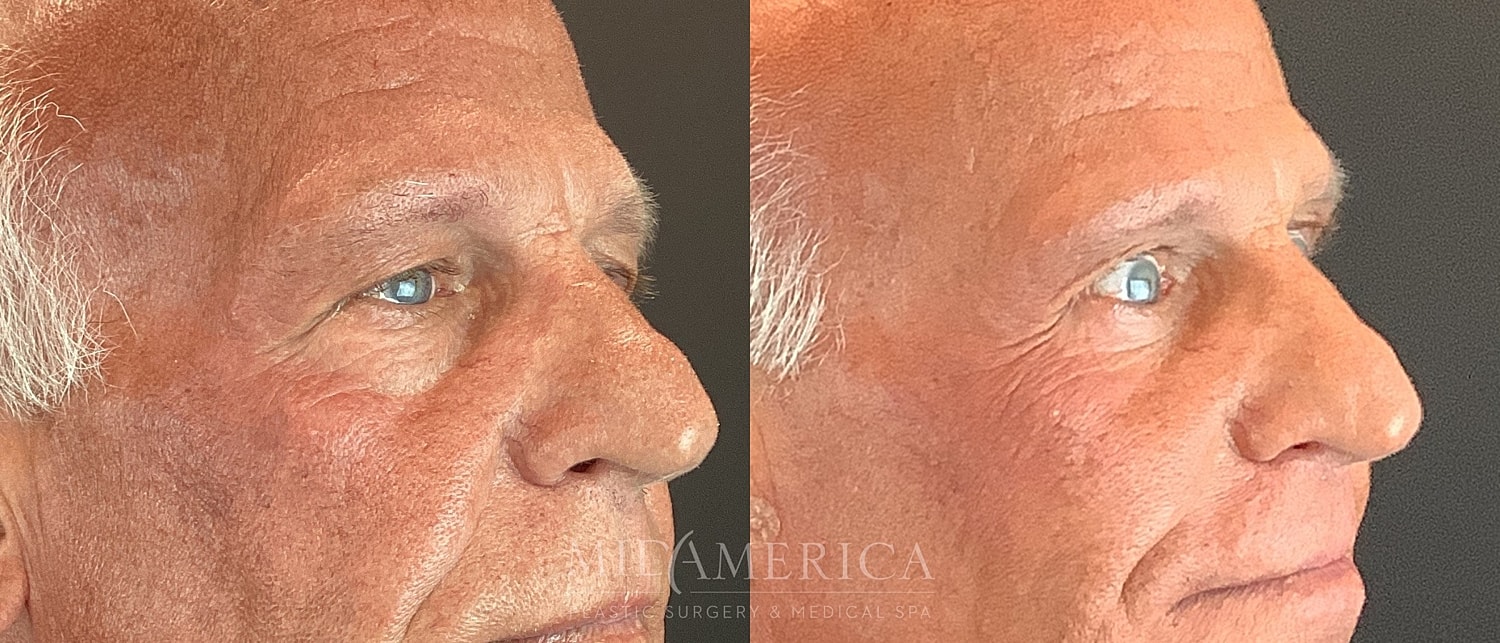 Lower Eyelid Surgery Before & After