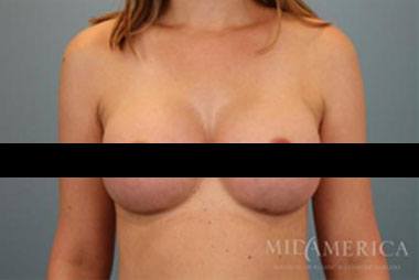 Patient after breast augmentation surgery