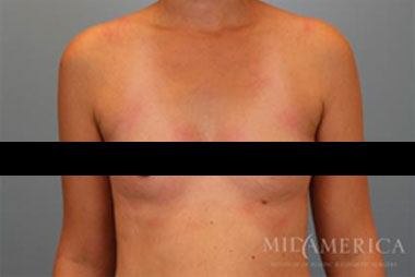 Patient before breast augmentation surgery