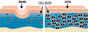 Diagram of amount of collagen before (less) and after (more)
