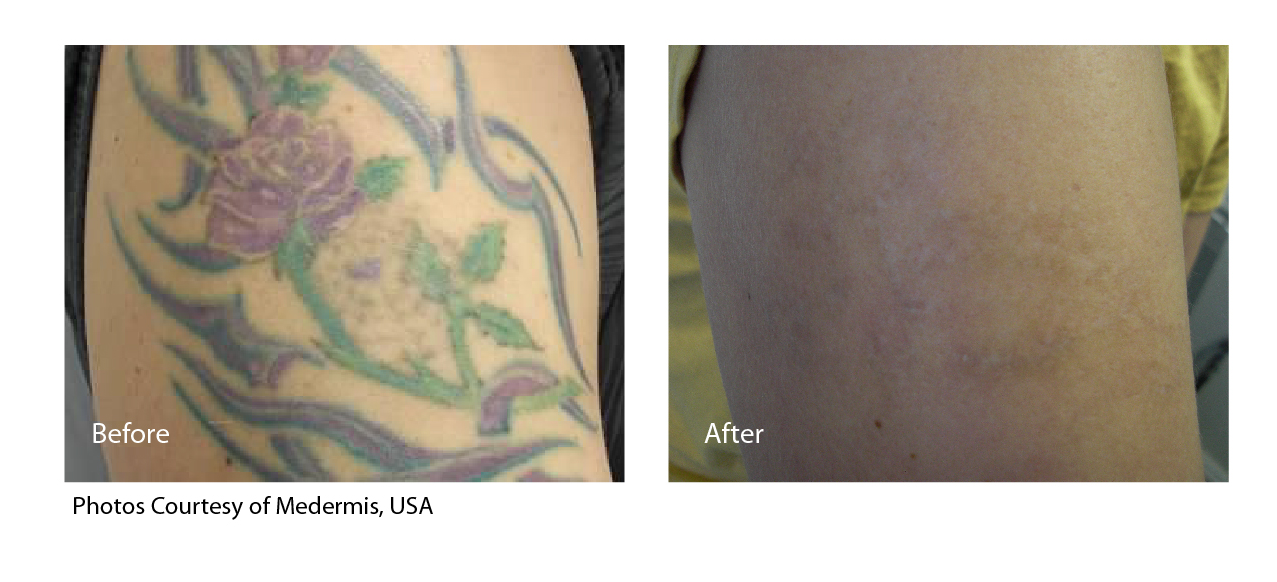 Tattoo Removal Ipswich. Removing the unwanted tattoo | Before the Lines