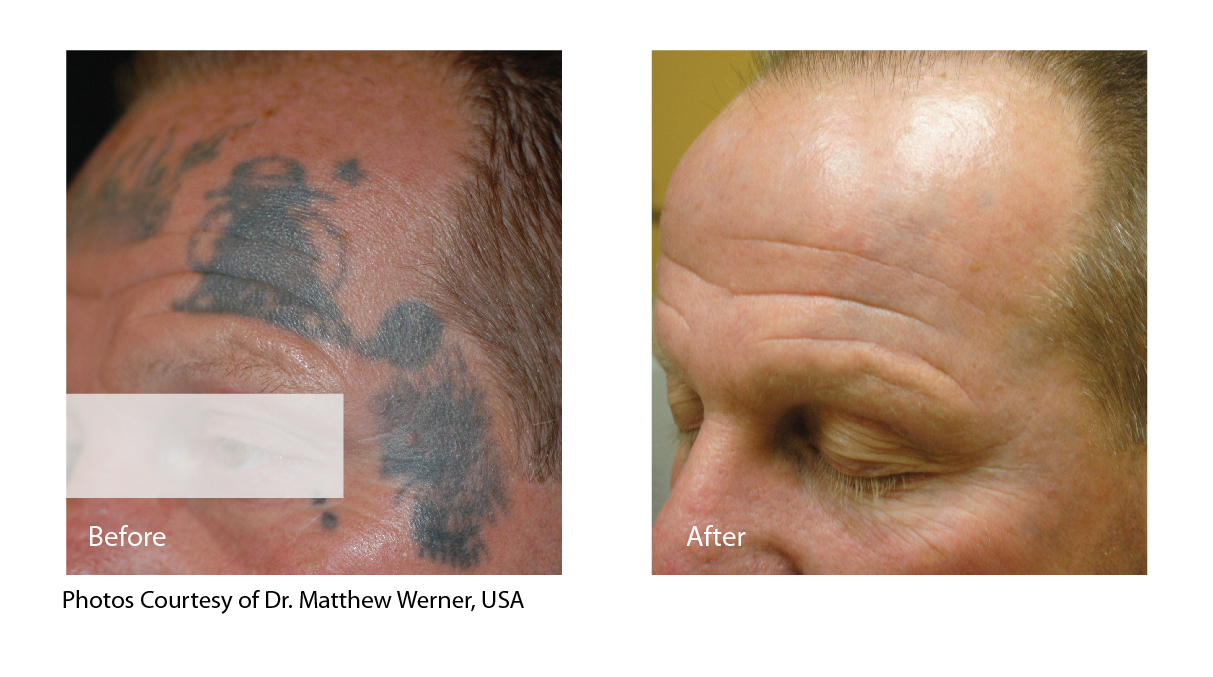 PDF) Increased Tattoo Fading in a Single Laser Tattoo Removal Session  Enabled by a Rapid Acoustic Pulse Device: A Prospective Clinical Trial