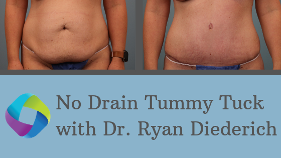 Tummy Tuck: Purpose, Procedure, Before and After Photos, and More