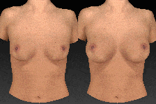 Vectra Breast Augmentation Animation