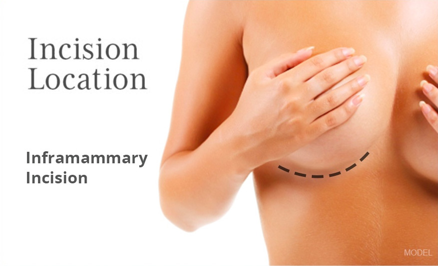 Breast Augmentation Incision Locations for an inframammary incision
