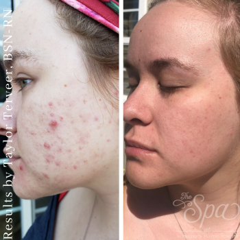 Before and after forever clear laser acne treatment at The Spa at MidAmerica Plastic Surgery in Glen Carbon, IL.